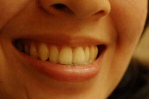 denti sorriso prevenzione fluoro