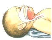 posizione neutra, disostruzione pediatrica, strozzamento, soffocamento